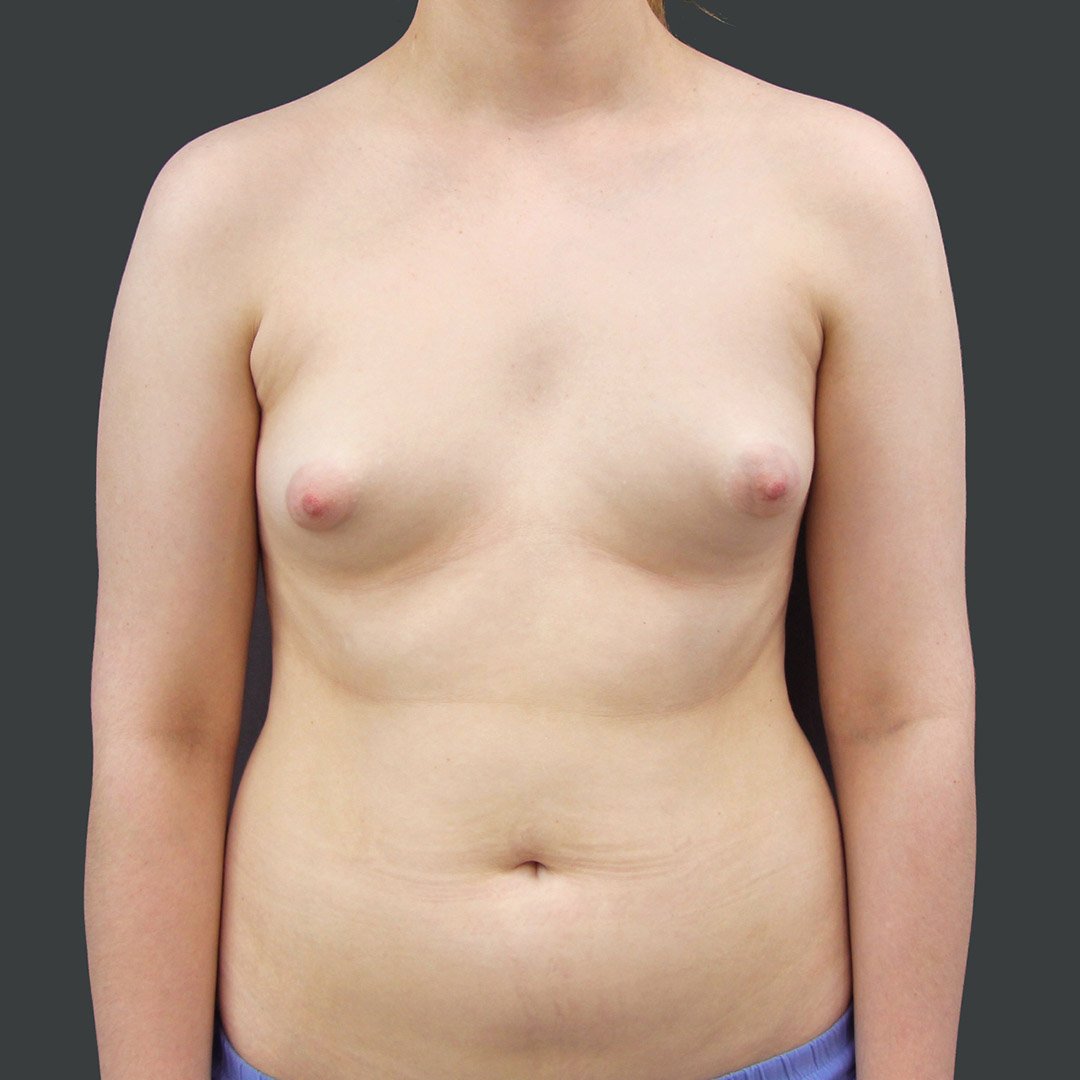 грудь тубулярная у женщин фото 66