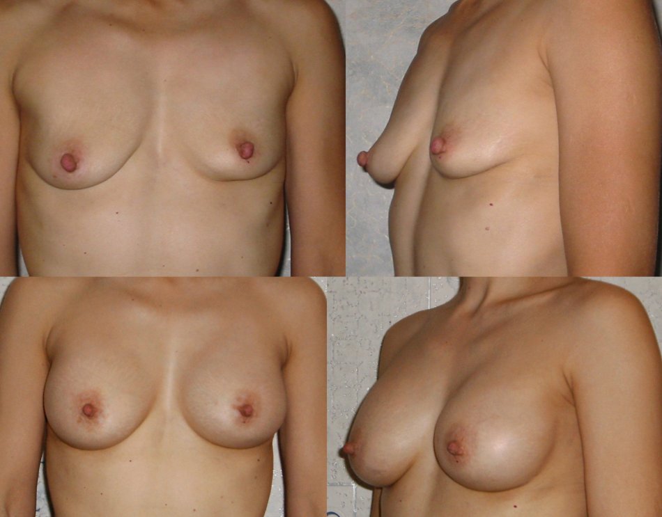 некрасивая голая женская грудь