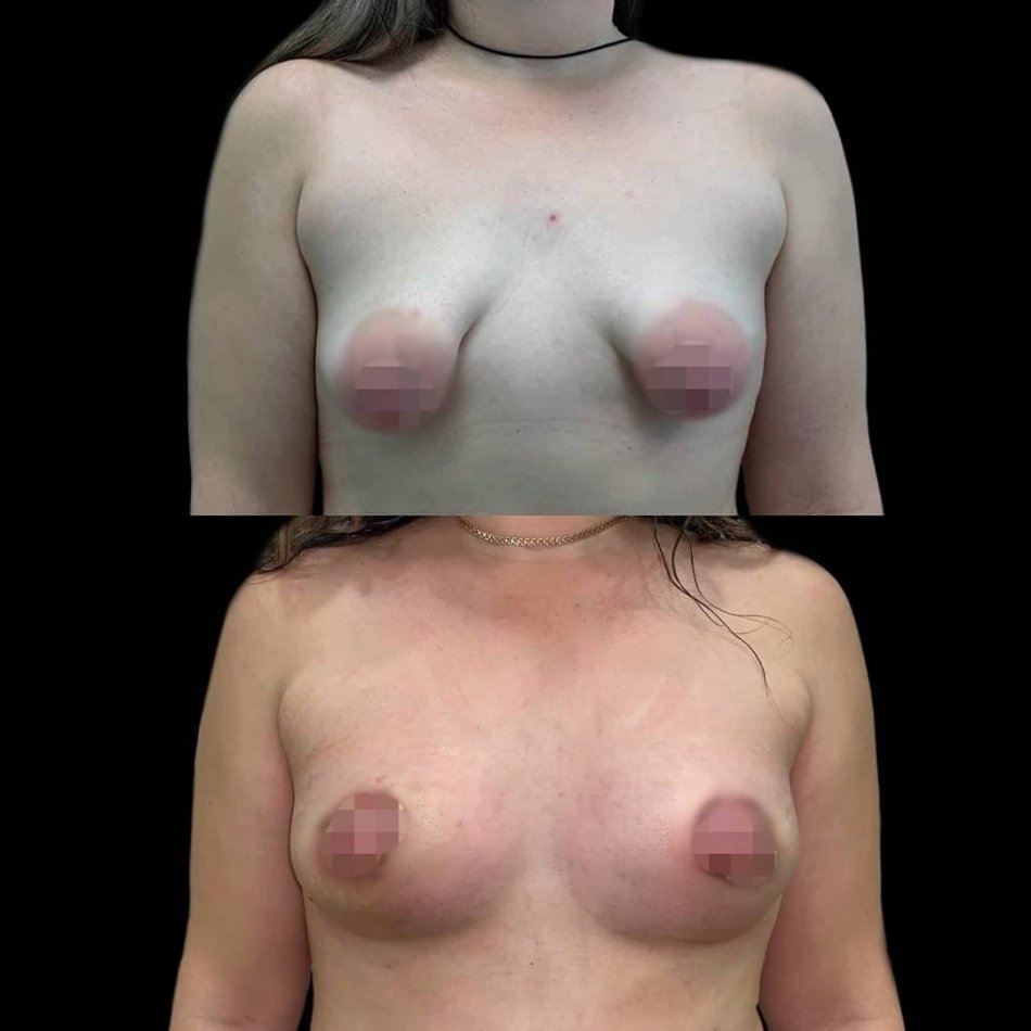 туберозное заболевание груди у женщин (119) фото
