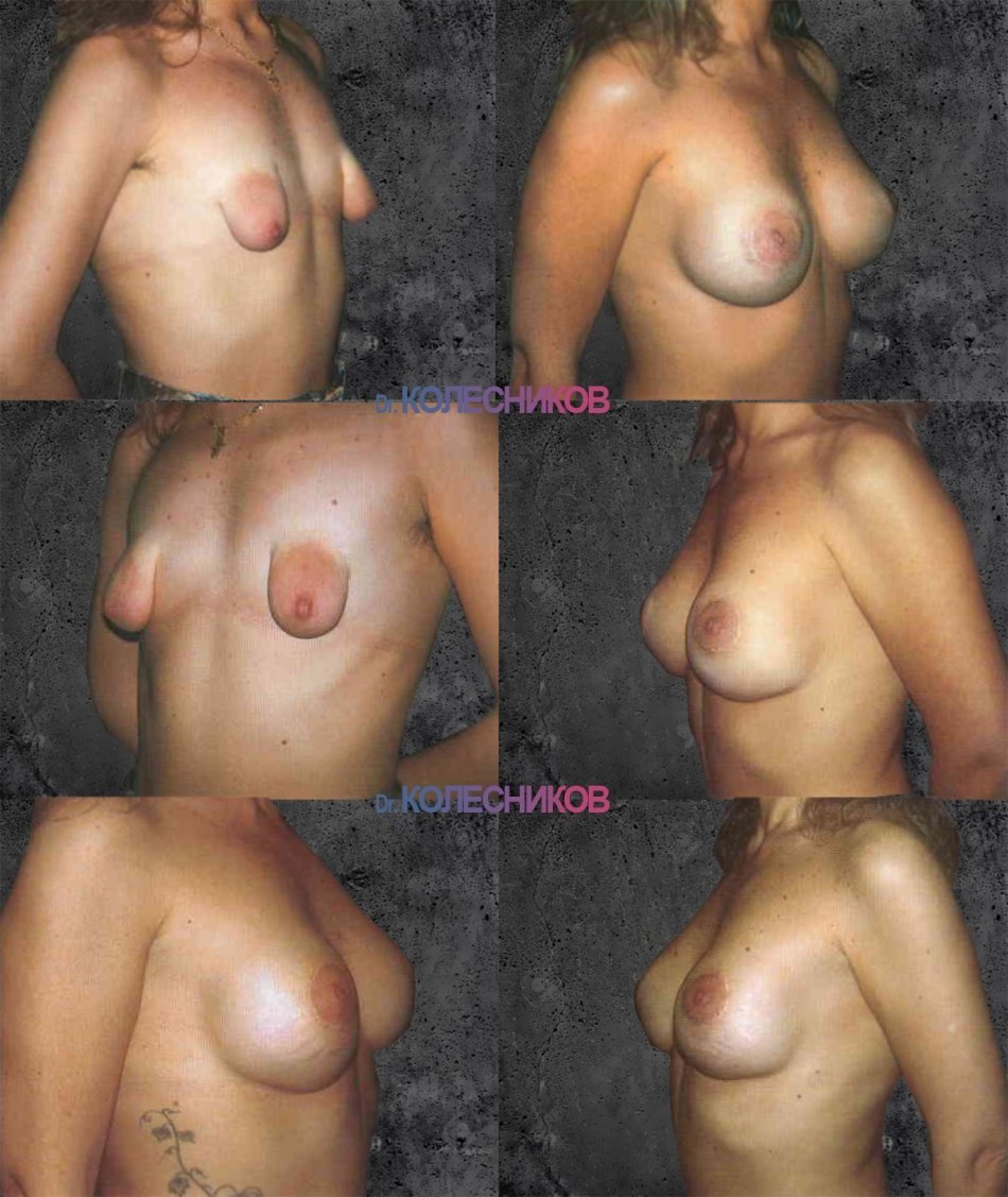 тубулярная деформация груди у женщин фото 10
